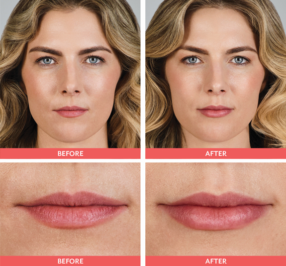 lip filler las vegas