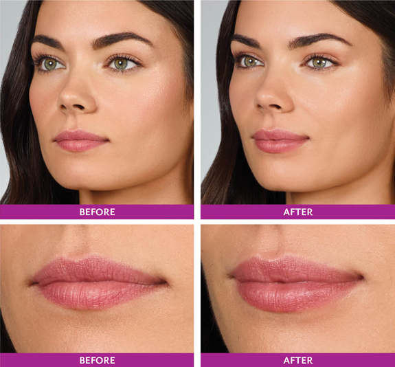 Lip filler las vegas